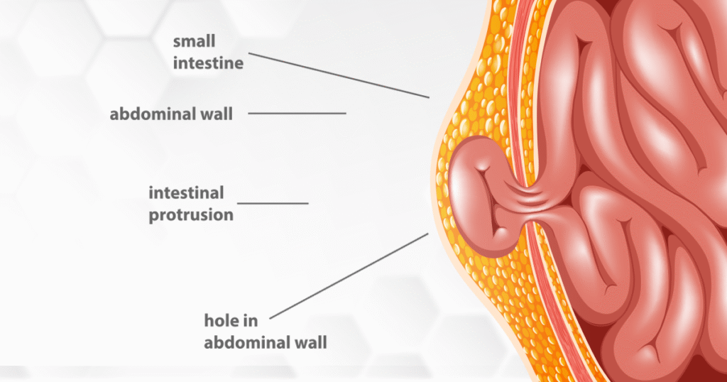 Inguinal hernia surgeon london