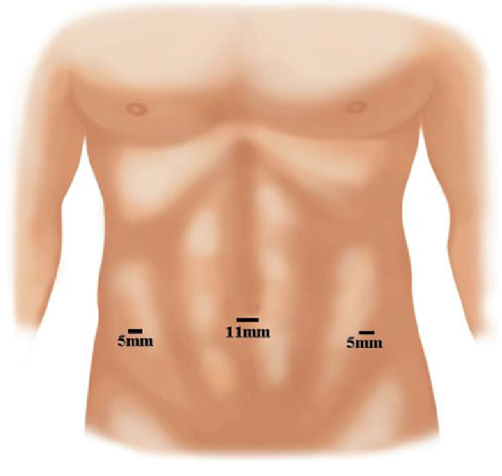 Keyhole hernia surgery